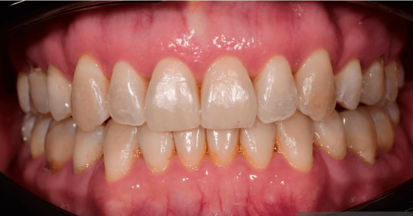 Orthodontics after