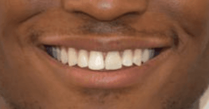 Orthodontics with Implant after