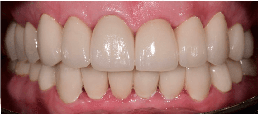 Oral Rehabilitation after