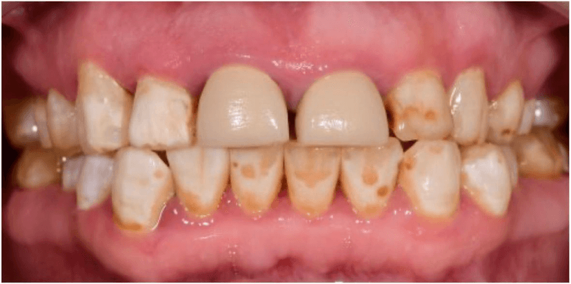 Oral Rehabilitation before